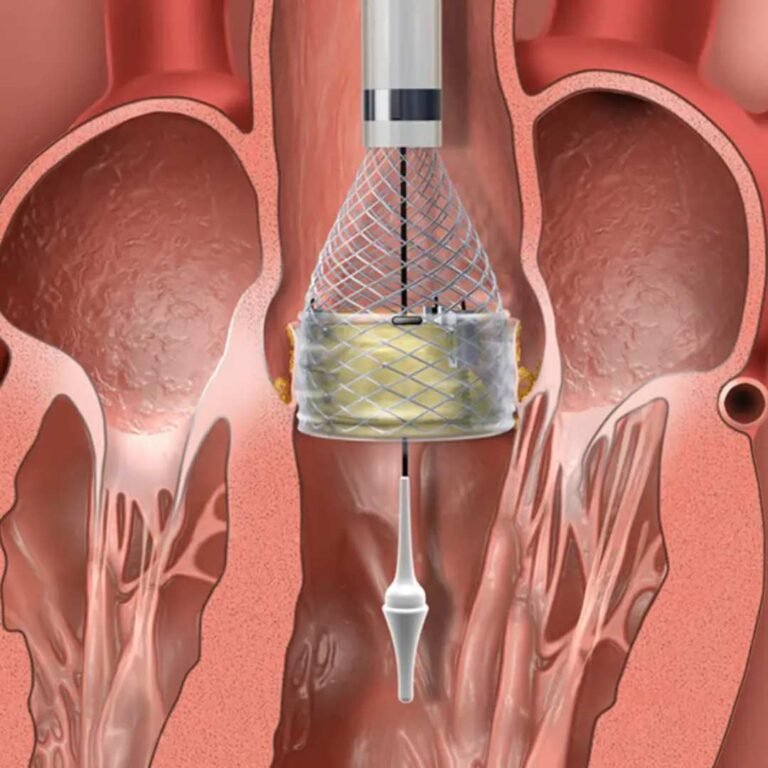 Transcatheter Aortic Valve Implantation