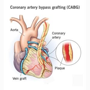 Coronary Artery Bypass Grafting