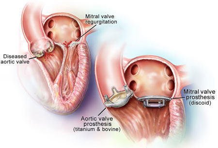 Valve Repair and Replacement
