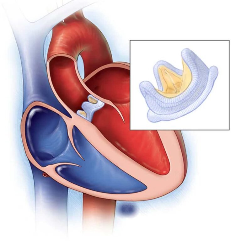 Valvular Repair and Replacement